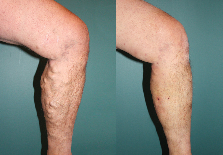 Foto de cirurgia de varizes antes e depois