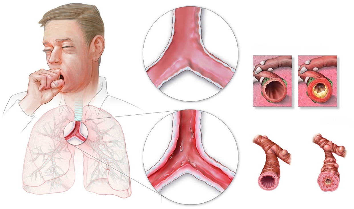 Bronquite crônica causa tosse