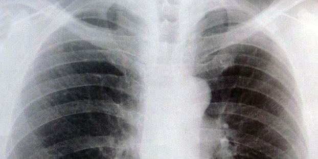 radiografia de tórax com sintomas de bronquite crônica