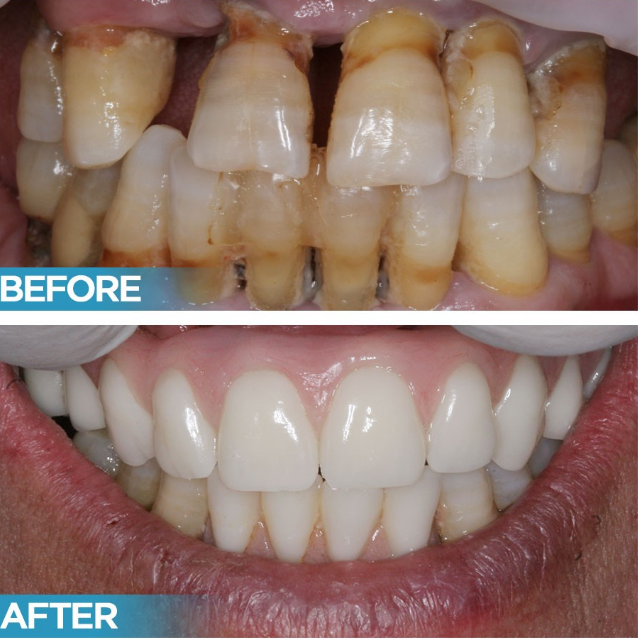 implantes dentários antes e depois