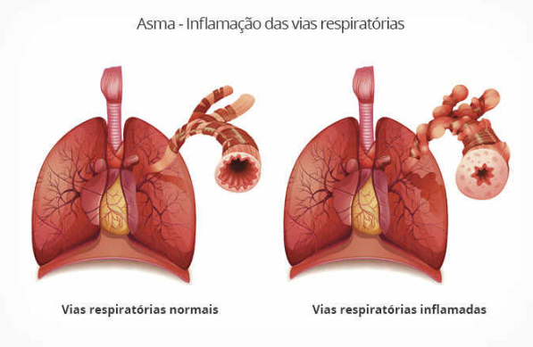 asma é uma inflamação das vias respiratórias