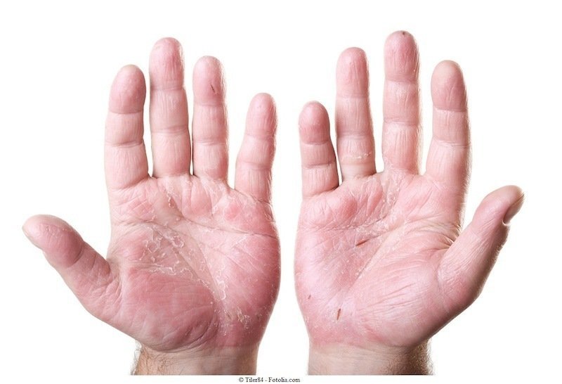 dermatite nas mãos