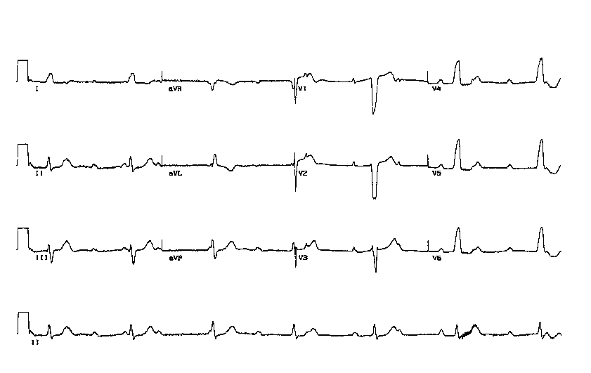 eletrocardiograma (ECG)