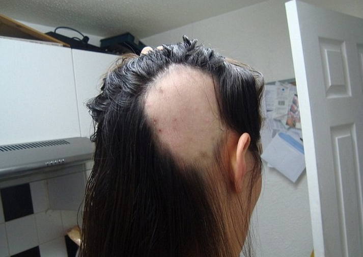 lupus eritematoso e queda de cabelo