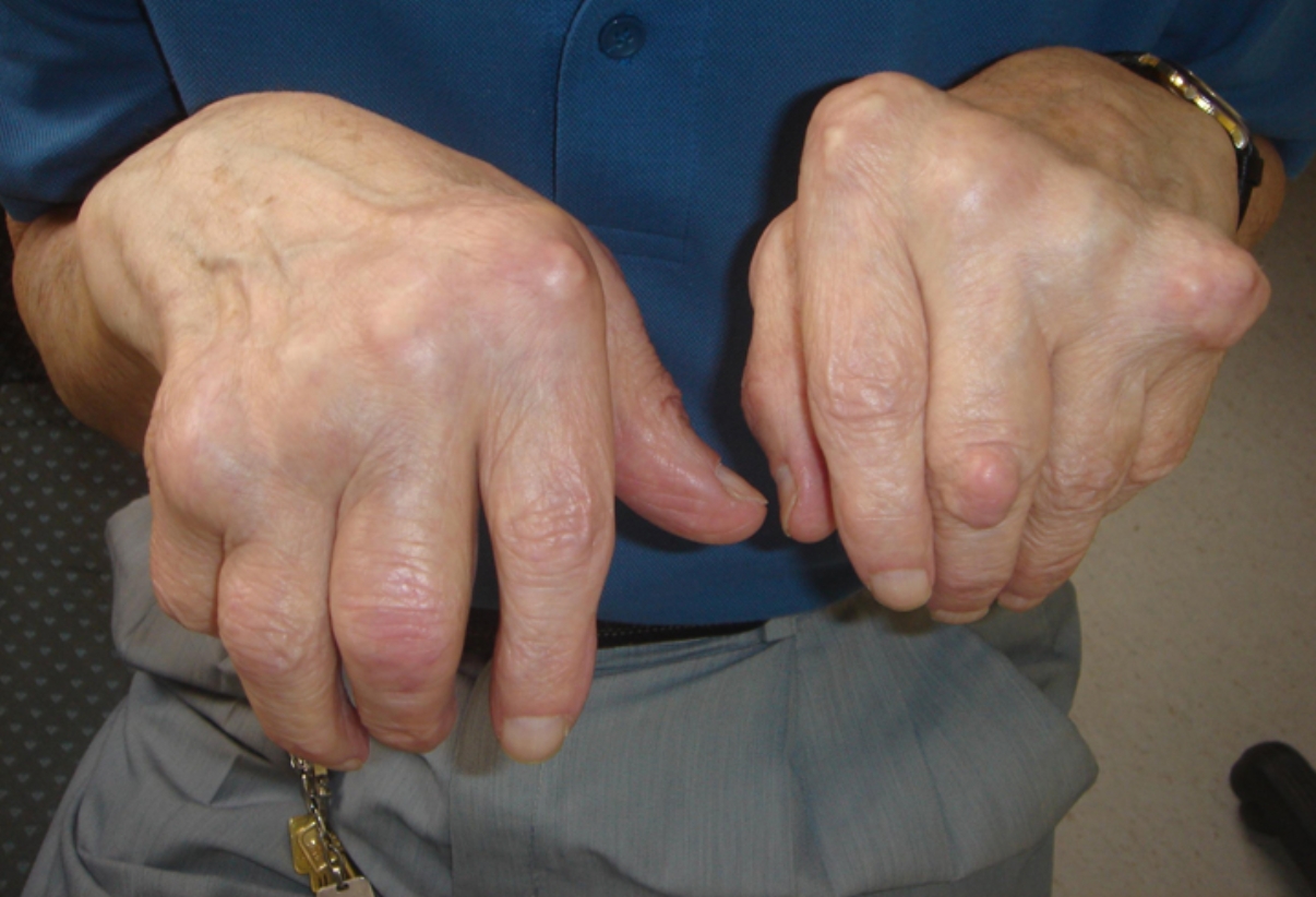 sintomas de artrite