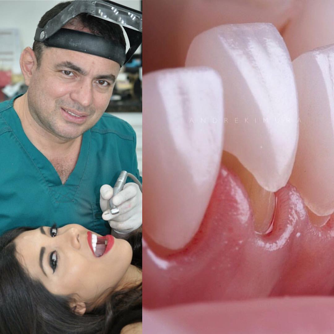 DR MARCELO MEDRANO ESPECIALISTA EN ESTÉTICA DENTAL 0990755754. diseño de sonrisa con carillas de porcelana marca E-max. SONRÍE !!!!!! Aprovecha nuestro 2x1 en limpieza moderna con ultrasonido marca coltene y te regalamos la revisión y el diagnóstico comp