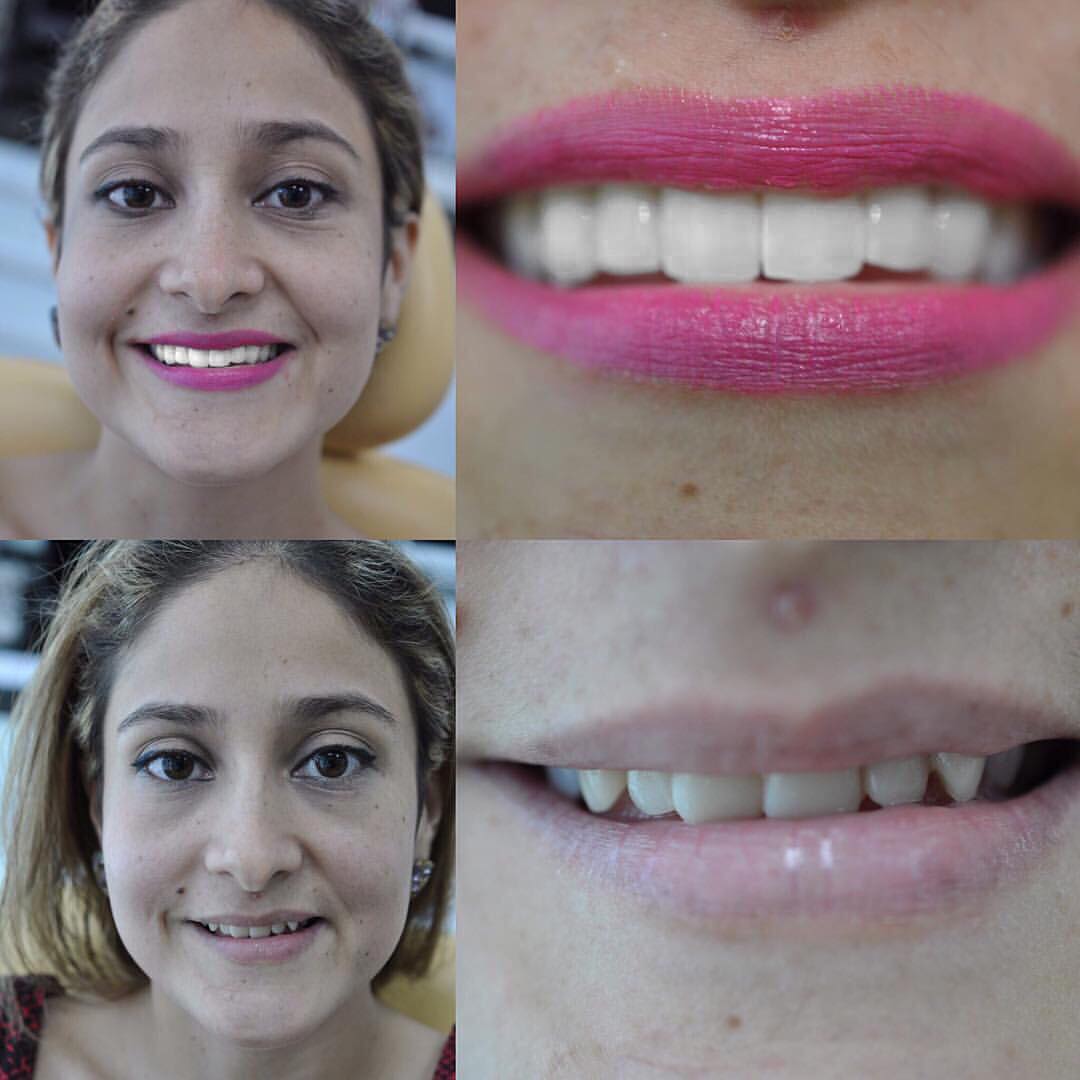 DR MARCELO MEDRANO ESPECIALISTA EN ESTÉTICA DENTAL 0990755754. diseño de sonrisa con carillas de porcelana marca E-max. SONRÍE !!!!!! Aprovecha nuestro 2x1 en limpieza moderna con ultrasonido marca coltene  y te regalamos la revisión y el diagnóstico comp