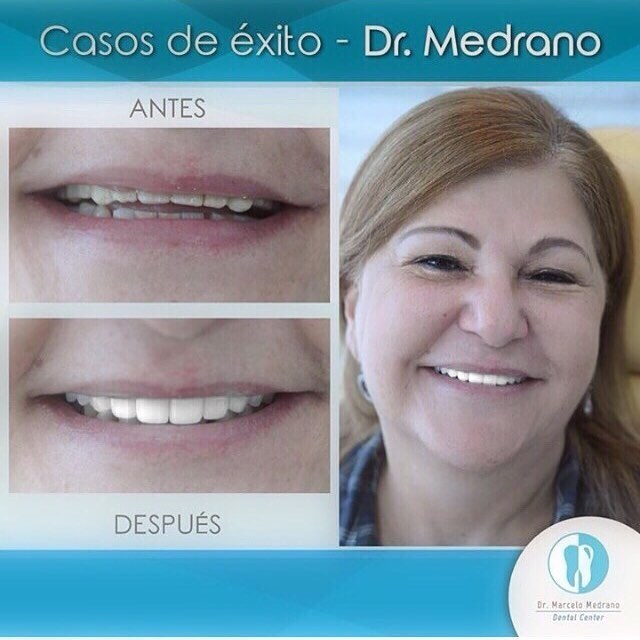 DR MARCELO MEDRANO ESPECIALISTA EN ESTÉTICA DENTAL 0990755754. diseño de sonrisa con carillas de porcelana marca E-max. SONRÍE !!!!!! Aprovecha nuestro 2x1 en limpieza moderna con ultrasonido marca coltene  y te regalamos la revisión y el diagnóstico comp